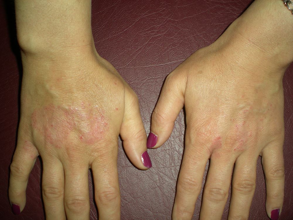 Alerjik Kontakt / Dermatit 
