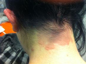 Saç Boyasına Bağlı Alerjik Kontakt Dermatit