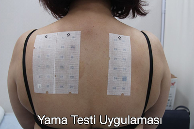 Deri Yama Testi (Skin Patch Test)